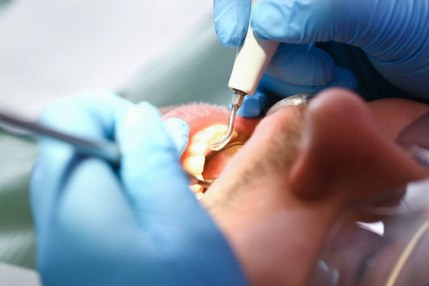 Best Emergency Tooth Extraction in Landover, MD